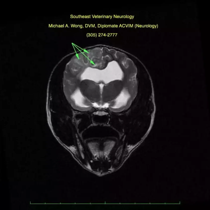 High Field Mri Encaphalitis