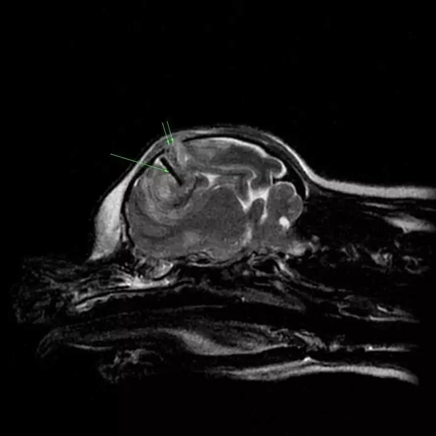 Removal Of Large Blood Clot